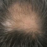 الصلع وزراعة الشعر