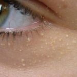 سبب ظهور حبوب ذات رؤوس بيضاء