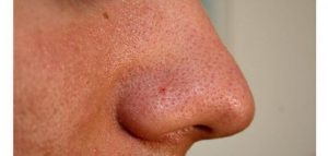طرق التخلص من الرؤوس السوداء على الأنف