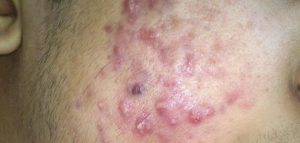 علاج حب الشباب والبقع طبيعياً